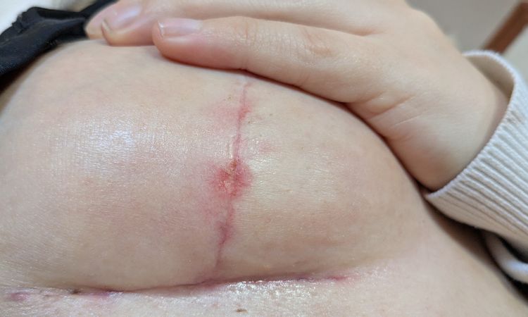 Wundheilung Brustnarbe nach knapp 5 Wochen - 83626