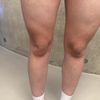 Delle nach liposuktion am Oberschenkel