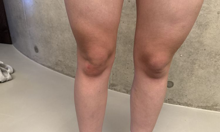 Delle nach liposuktion am Oberschenkel - 83691