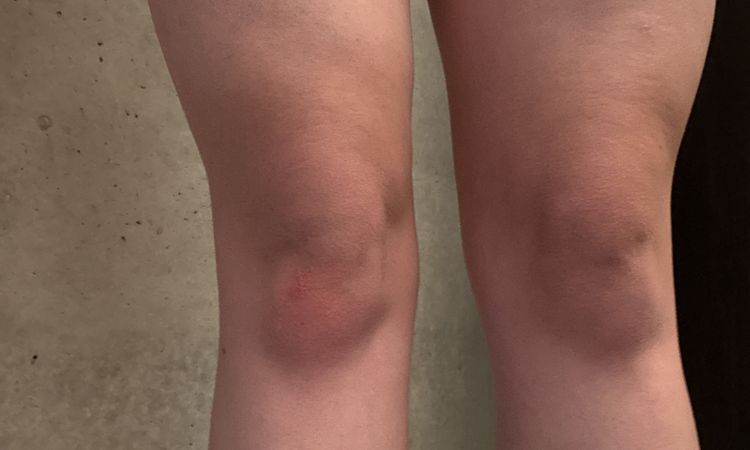 Delle nach liposuktion am Oberschenkel - 83693