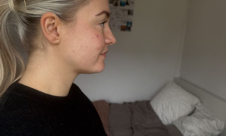 Lohnt sich hier eine Fettabsaugung am Kinn? - 83739