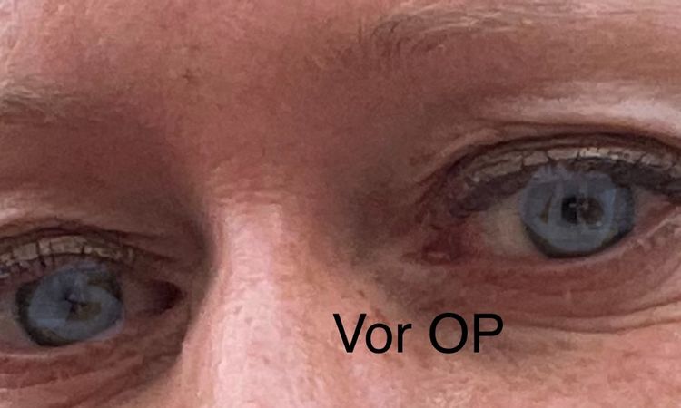 Probleme Nachts mit Lidschluss - 83742