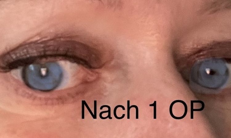 Probleme Nachts mit Lidschluss - 83743