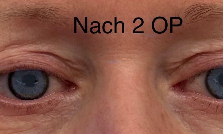 Probleme Nachts mit Lidschluss - 83745