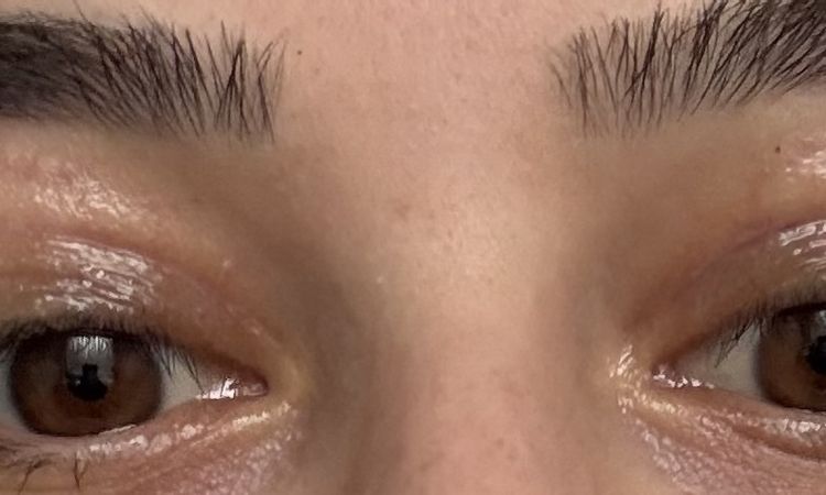 Lidstraffung  operativ leicht korrigiere? - 83784