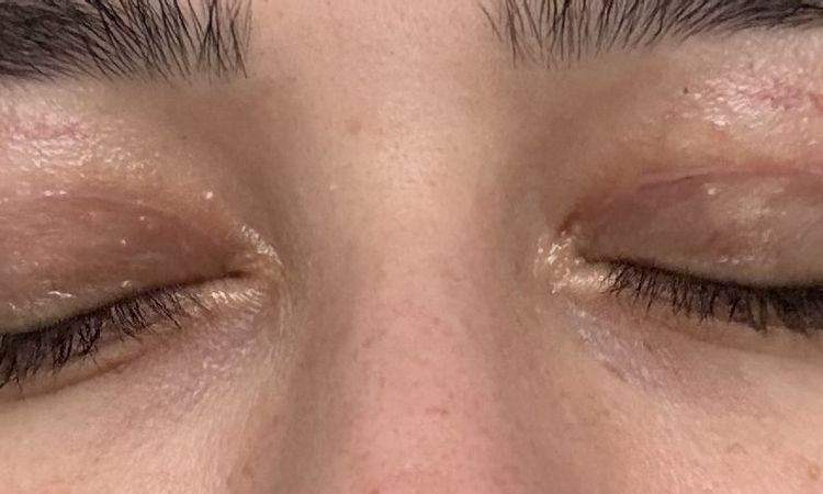 Lidstraffung  operativ leicht korrigiere? - 83785