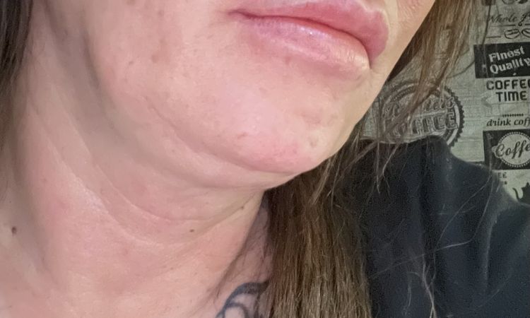 Keine Kinnlinie mehr - 83847