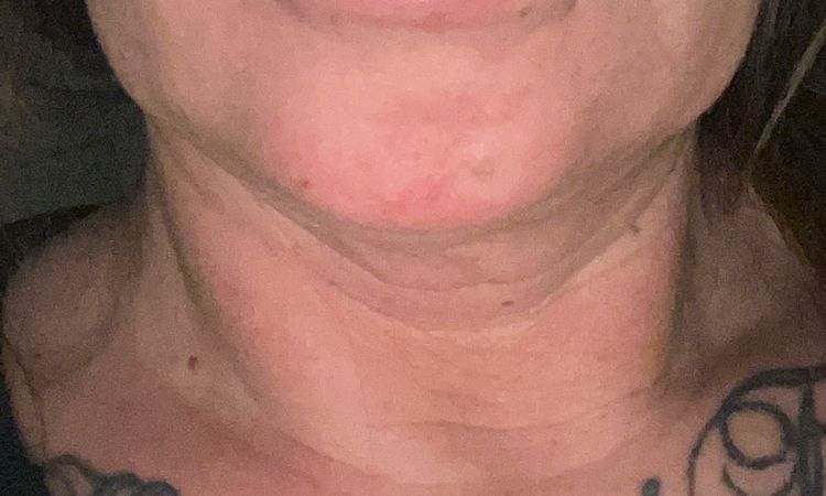 Keine Kinnlinie mehr - 83849