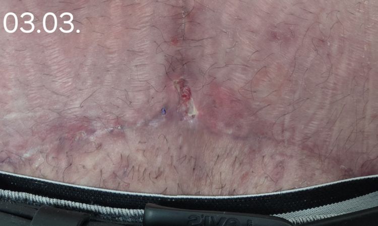 Wundheilungsstörung und Nässen nach Bauchdeckenstraffung - 83850