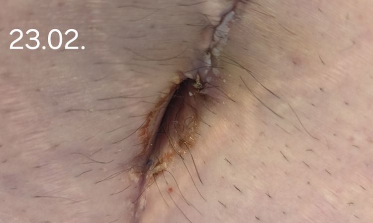 Wundheilungsstörung und Nässen nach Bauchdeckenstraffung - 83851