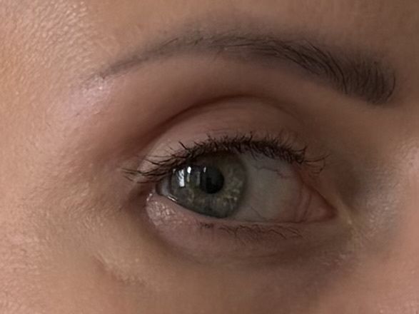 Unterlider nach OP stark ein - 83854