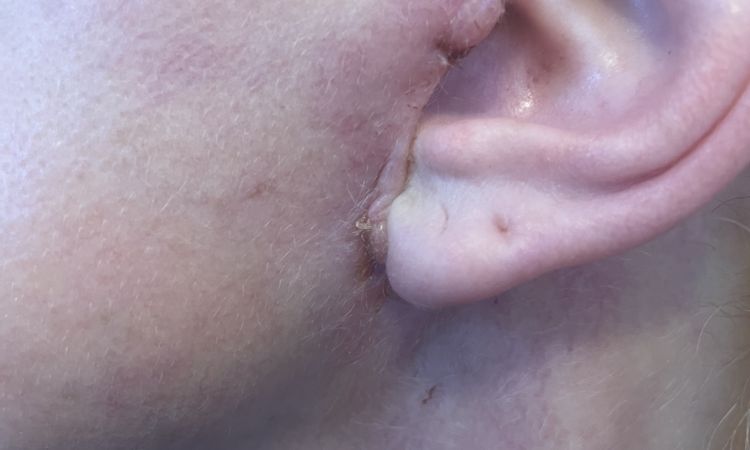 Narben and fehlender Haaransatz nach Facelift - 83905