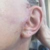 Narben and fehlender Haaransatz nach Facelift