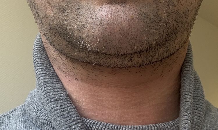 Hifu, Endolift, Laser, Kinn und Jawline - 83931