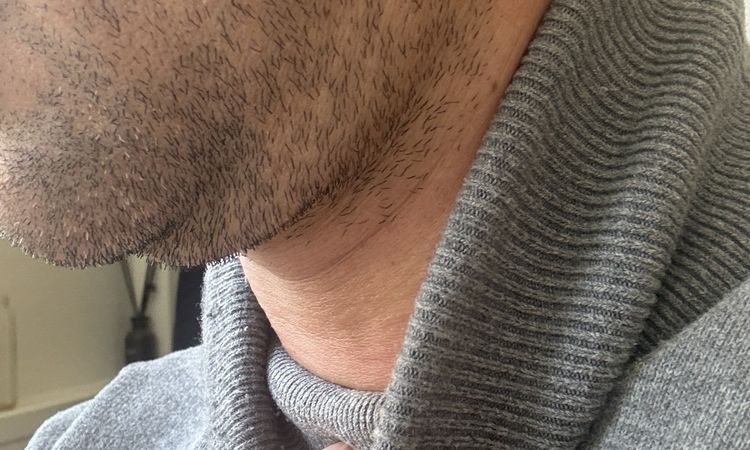 Hifu, Endolift, Laser, Kinn und Jawline - 83932