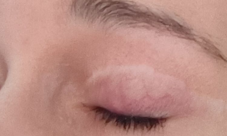 Weiße Narben behandeln - 83951