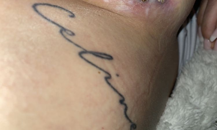 Erneutes aufgehen der Naht - 83953