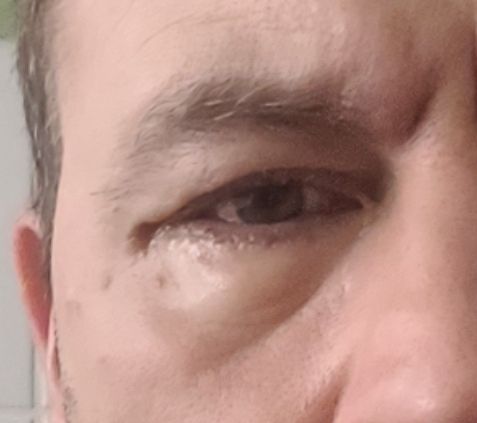 Keine Veränderung nach zweiter Unterlidstraffung - 83985