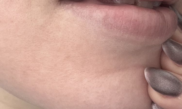 Revolax Deep Lippenunterspritzung Hyaluron - 83989