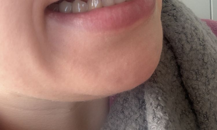 Revolax Deep Lippenunterspritzung Hyaluron - 83990