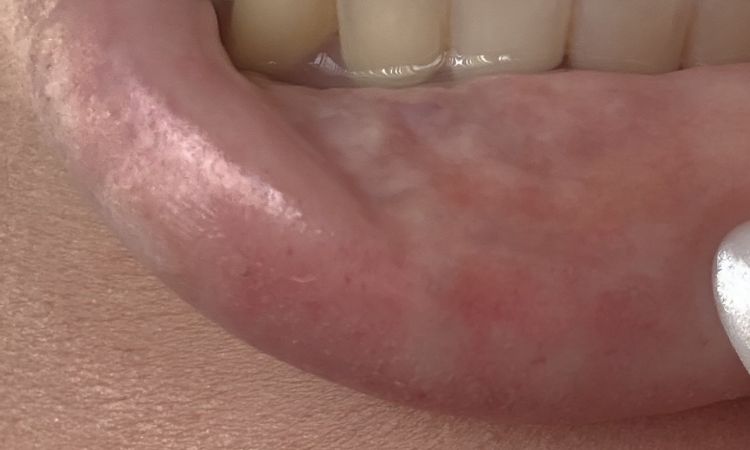 Revolax Deep Lippenunterspritzung Hyaluron - 83991