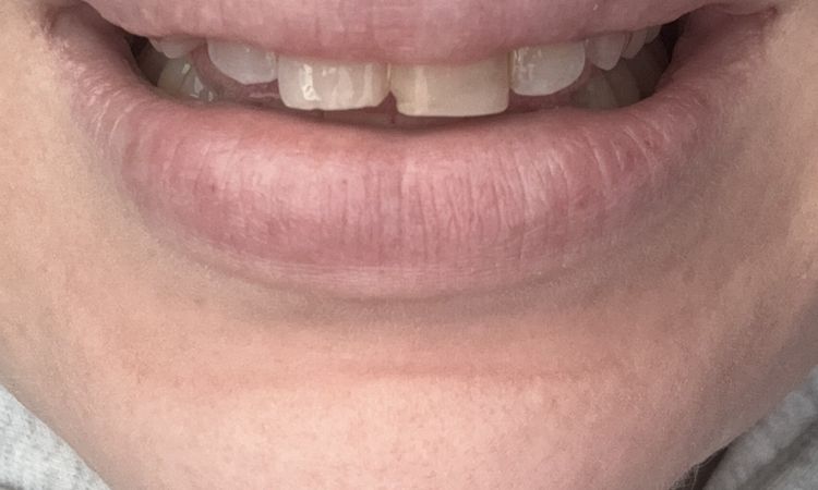 Revolax Deep Lippenunterspritzung Hyaluron - 83992