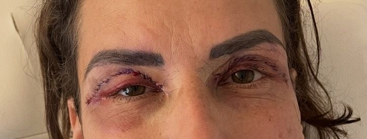 enstellt für immer nach lid op? - 83996