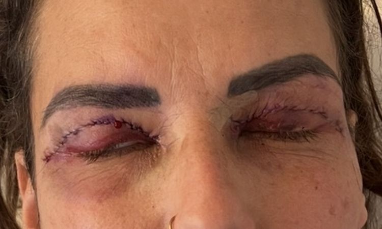 enstellt für immer nach lid op? - 83997