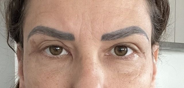 enstellt für immer nach lid op? - 83998