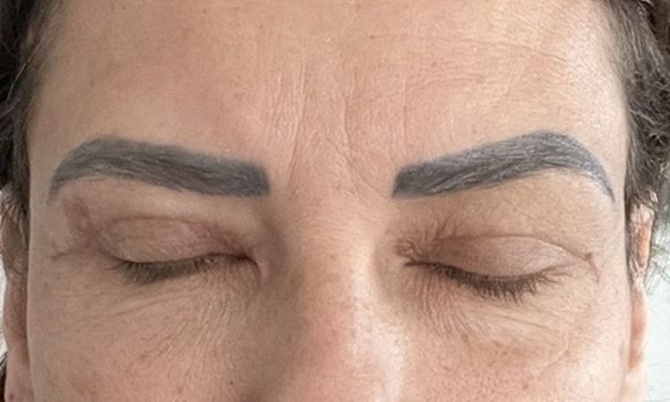 enstellt für immer nach lid op? - 83999