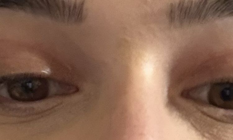 Lidstraffung  gehabt nicht zufrieden - 84006