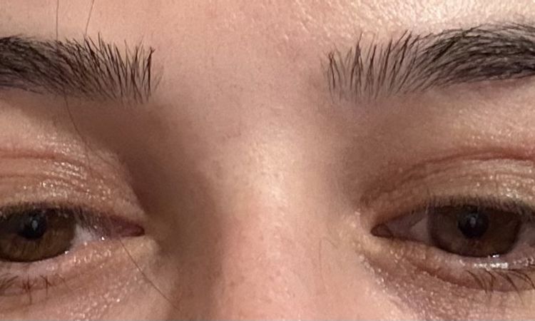 Lidstraffung  gehabt nicht zufrieden - 84007