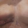 Unschöne Form nach Lipofilling in der Brust