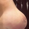 Unschöne Form nach Lipofilling in der Brust
