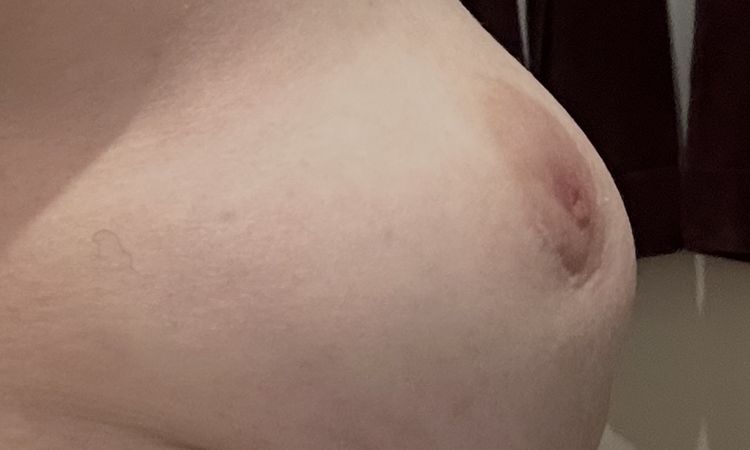 Unschöne Form nach Lipofilling in der Brust - 84020