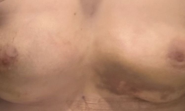 Unschöne Form nach Lipofilling in der Brust - 84023