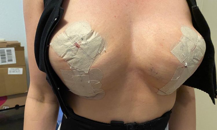 Kann nachträglich Gewebe entfernt werden ohne die Brustwarzen zu versetzen ? - 84033