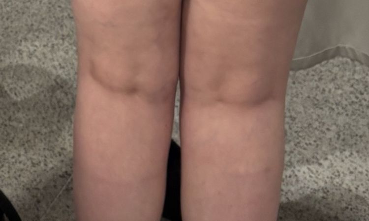 Fettabsaugung schief gelaufen - 84047