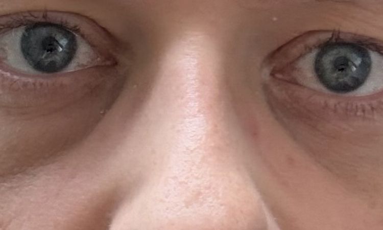 Verfärbung/Hämatom nach Unterspritzung der Tränenrinne - 84060