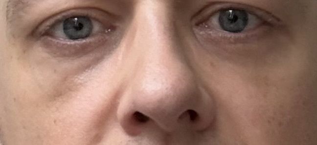 Verfärbung/Hämatom nach Unterspritzung der Tränenrinne - 84061