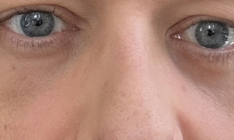 Verfärbung/Hämatom nach Unterspritzung der Tränenrinne - 84062