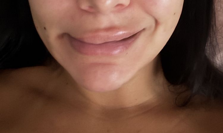 Lähmung nach Endolift - 84105