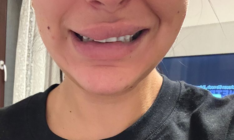 Lähmung nach Endolift - 84106