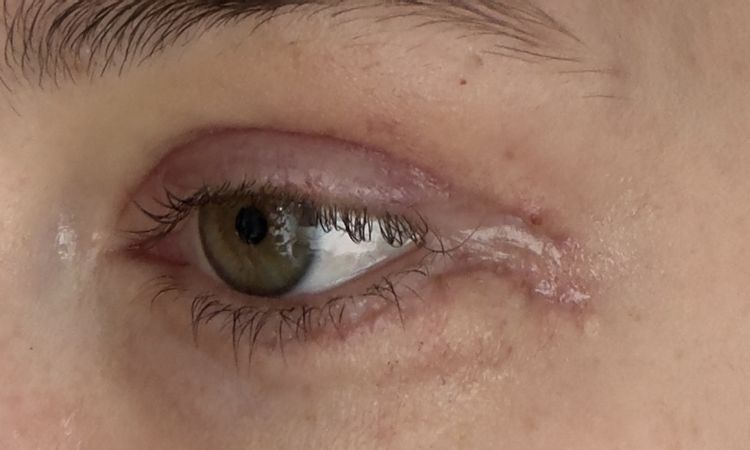 Knubbel nach Ober- Unterlidstraffung - 84107