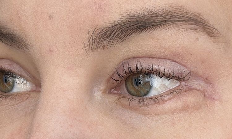 Knubbel nach Ober- Unterlidstraffung - 84108