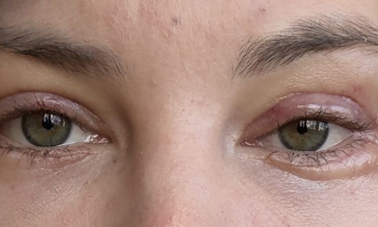 Knubbel nach Ober- Unterlidstraffung - 84109