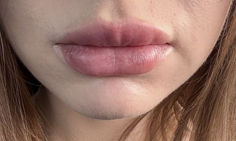 Kinn und Lippe schief, passiert sowas oder doch zu einem anderen Artz wechseln? - 84130