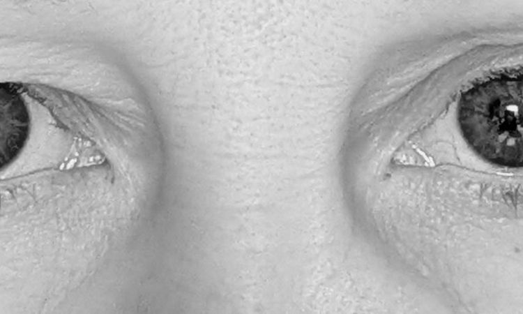 Oberlidstraffung ja oder nein? - 84165