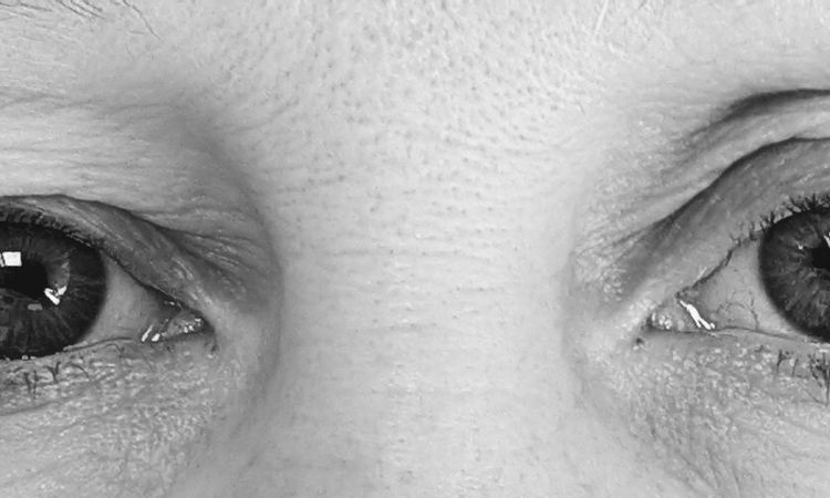 Oberlidstraffung ja oder nein? - 84166