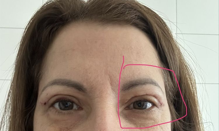 Wellige Haut am Oberlid - 84176